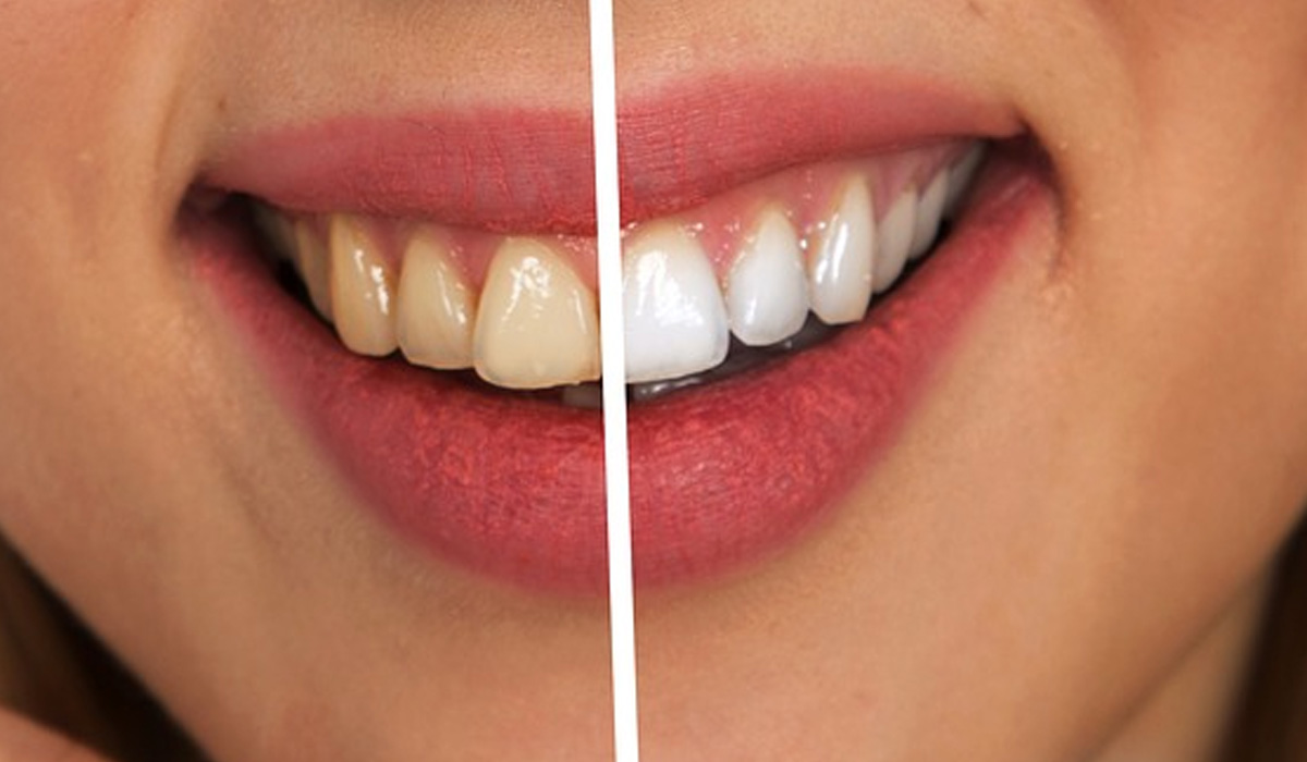 before and after stained teeth treatment