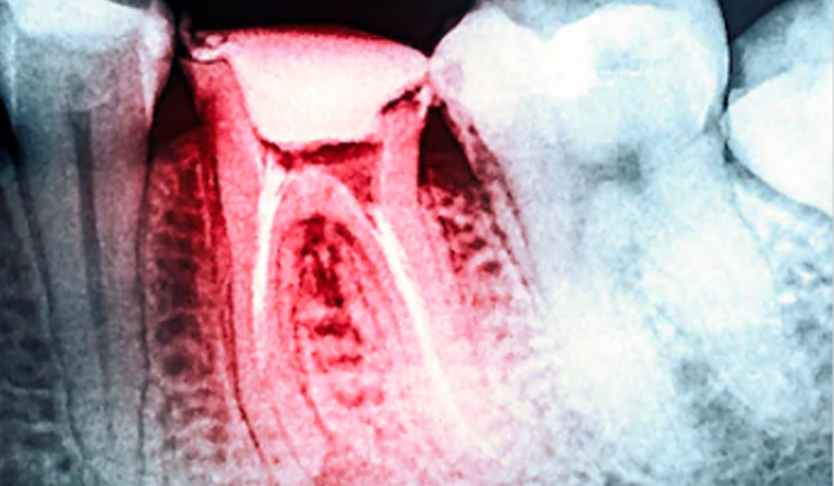 x-ray about root canal