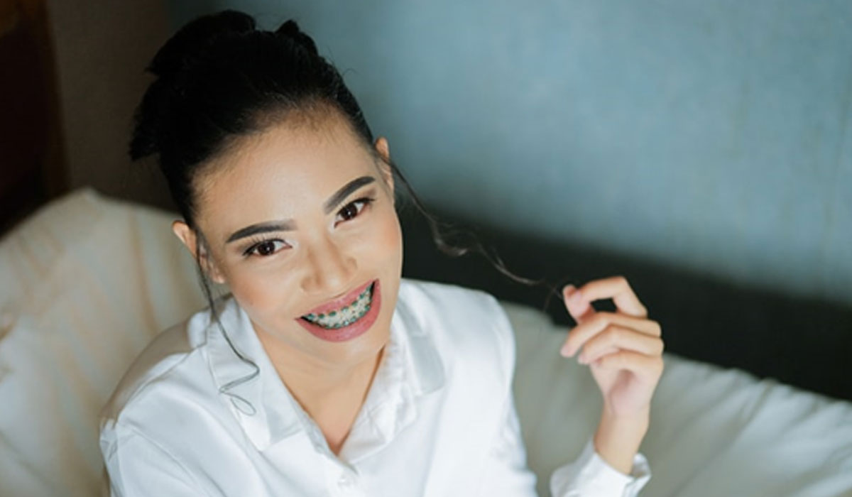 woman smiling after wearing braces
