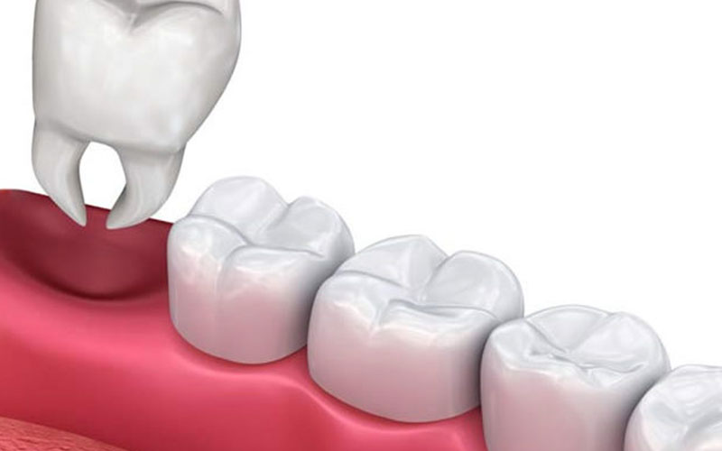 tooth extraction in NW Calgary