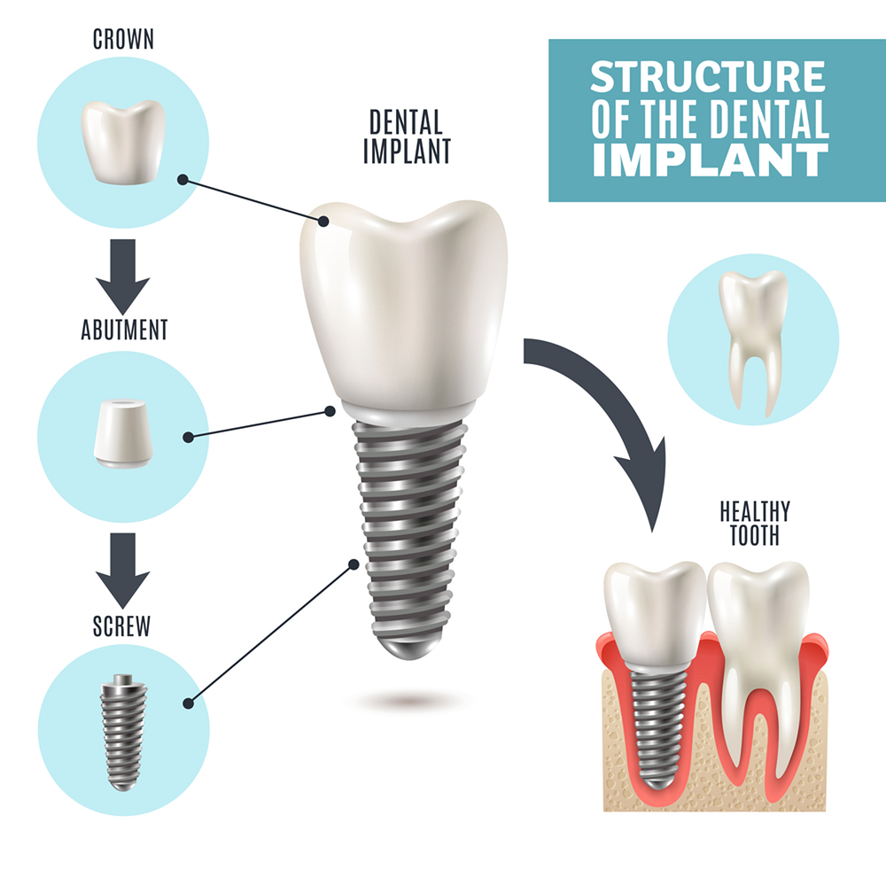 dental implant procedure structure