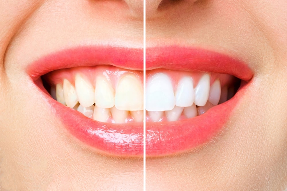 Does Teeth Whitening Work And Is It Safe Valley Ridge Dental Centre