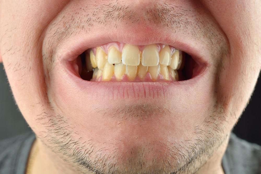 man having yellow teeth stain