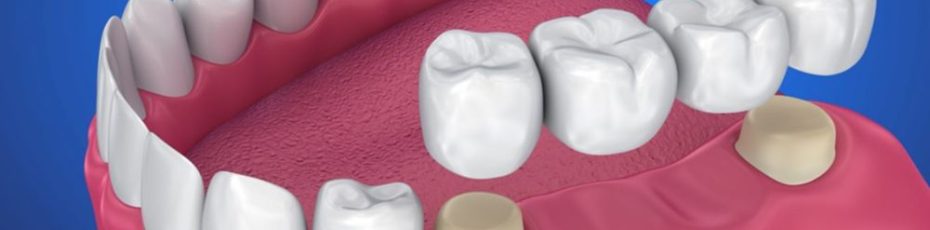 How to Care For Your Dental Bridge: Tips For Long-Lasting Results