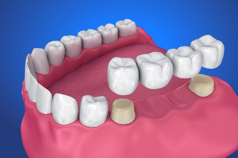 How to Care For Your Dental Bridge: Tips For Long-Lasting Results