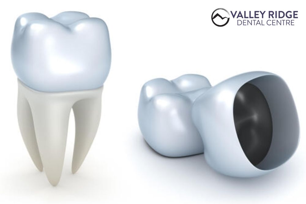What Are the Steps of a Crown Procedure?