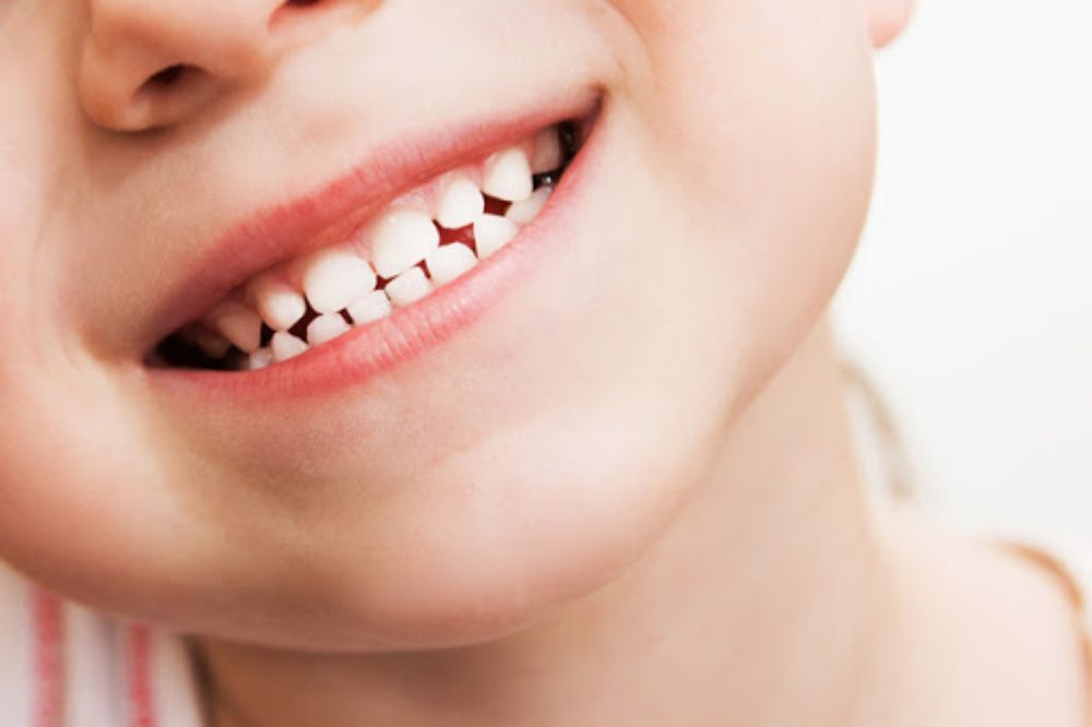 What Is Early Childhood Tooth Decay?