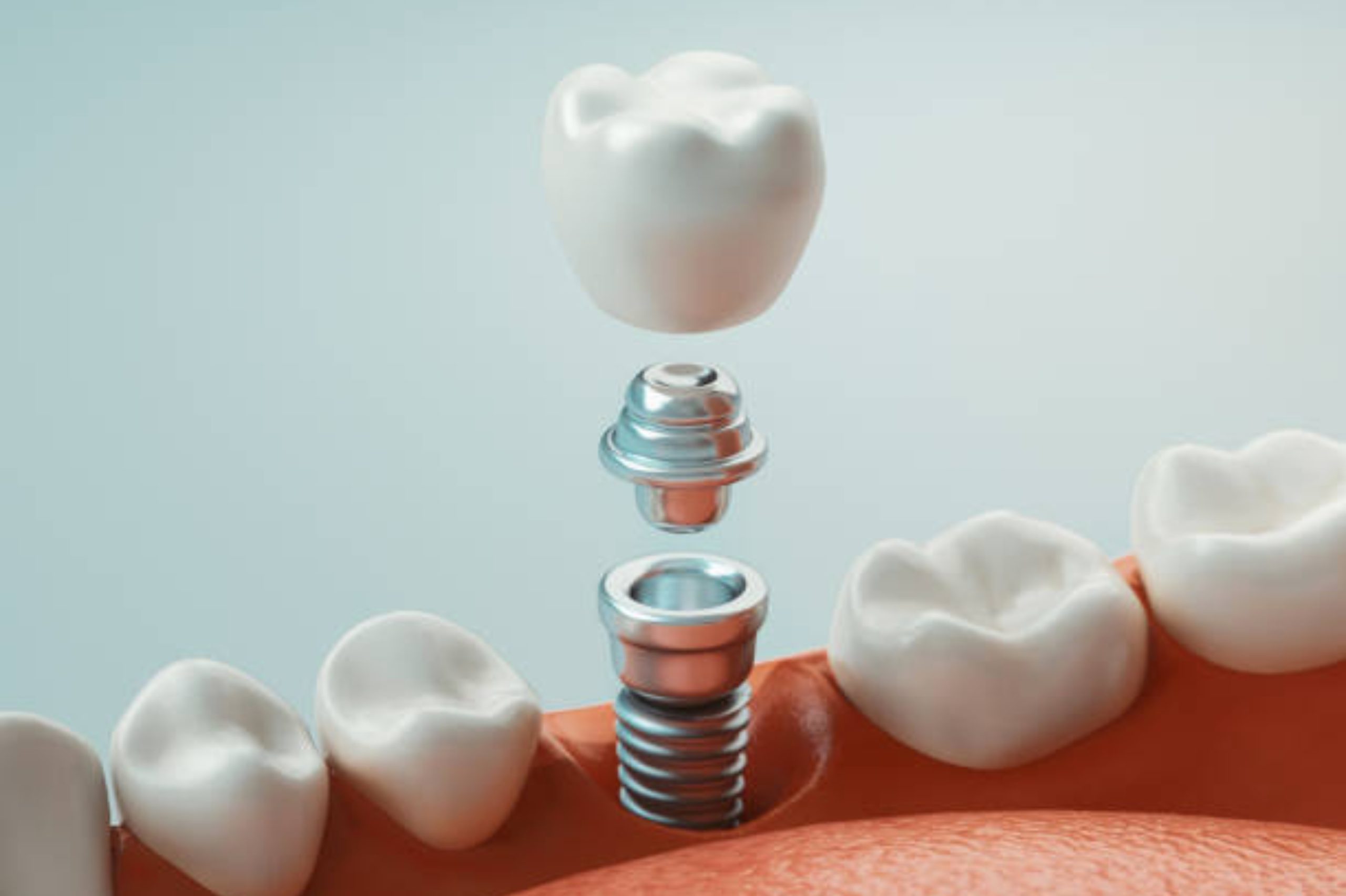 Dental implant being placed in a patient’s jaw