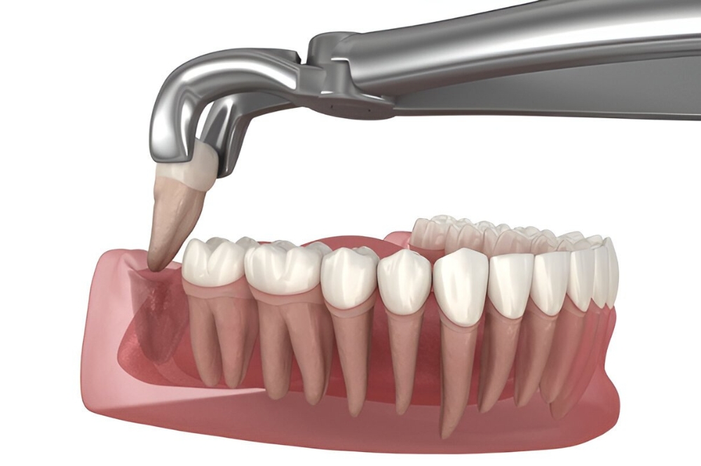 When Is a Tooth Extraction Necessary? Signs You May Need It in Calgary