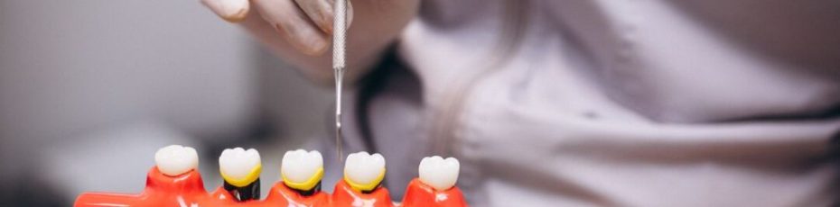 What Exactly Is a Dental Bridge? A Simple Guide to How It Works and When You Need One