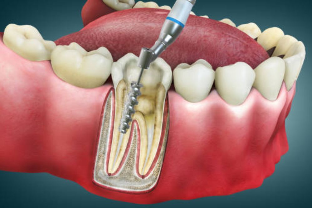 In and Out: Can I Get My Root Canal Done in a Single Appointment?
