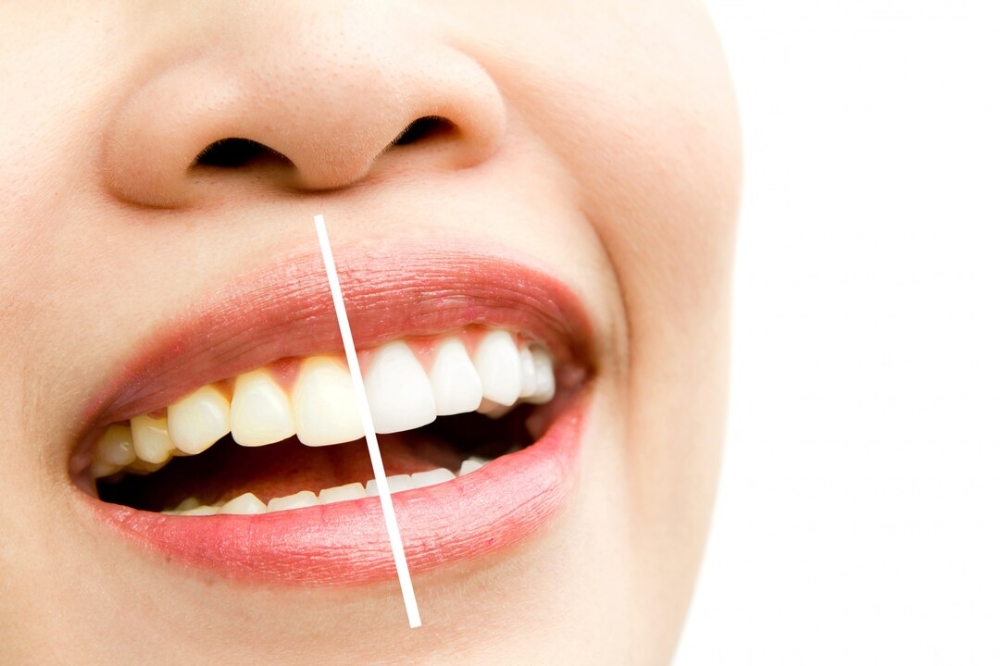 How Often Should You Get Teeth Whitening Treatments? Recommended Frequency for Best Results