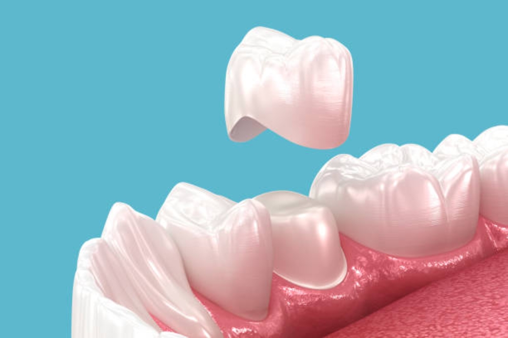 How Does the Dental Implant Procedure Work? Step-by-Step Timeline From Start to Finish