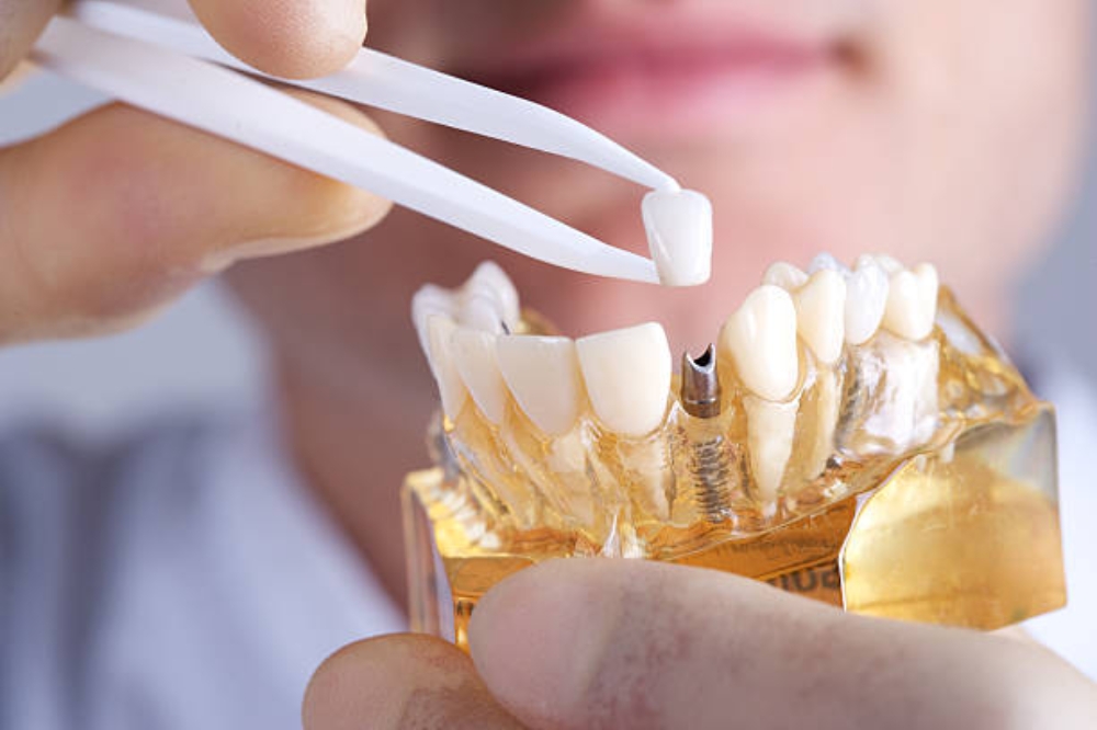 Dental Implants: A Complete Guide to the Procedure and Recovery