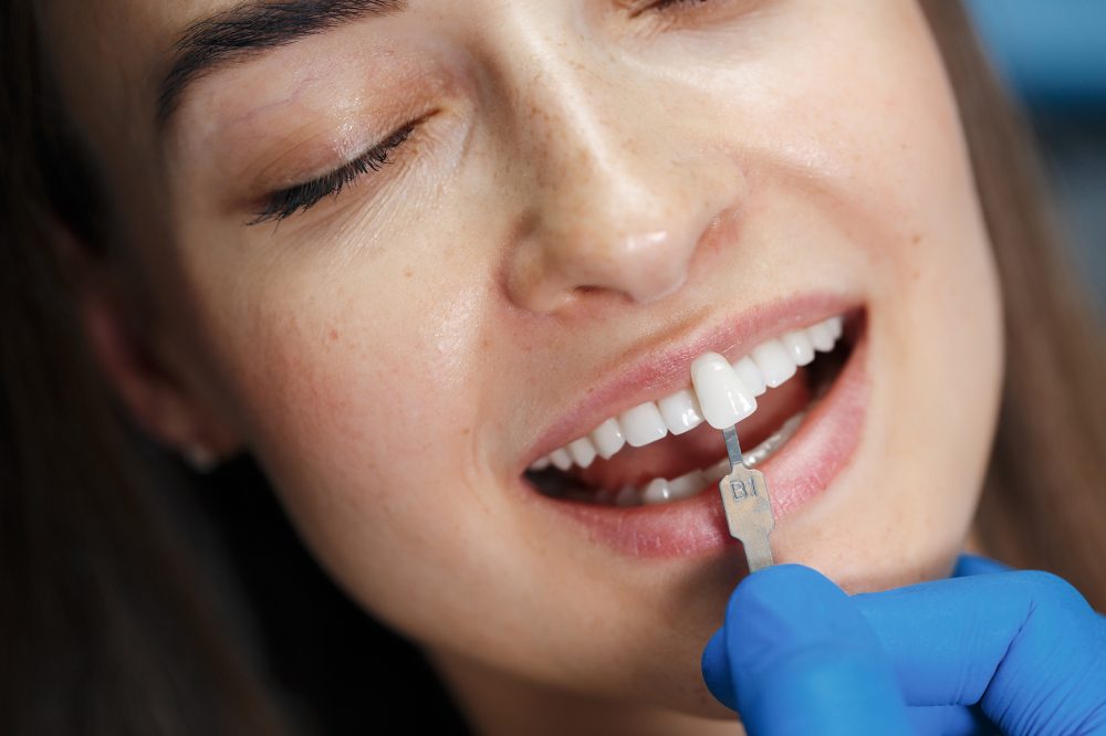 five-common-dental-veneer-myths-you-need-to-stop-believing